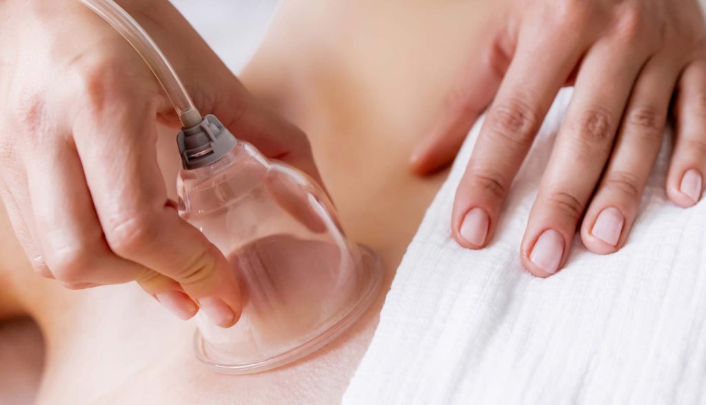 Myofascial cupping therapy on the lower back to relieve muscle tension and improve mobility at Toccare Massage on the Sunshine Coast.